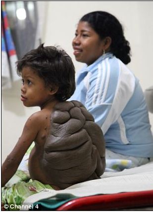 Turtle boy: Child's back mole resembles shell