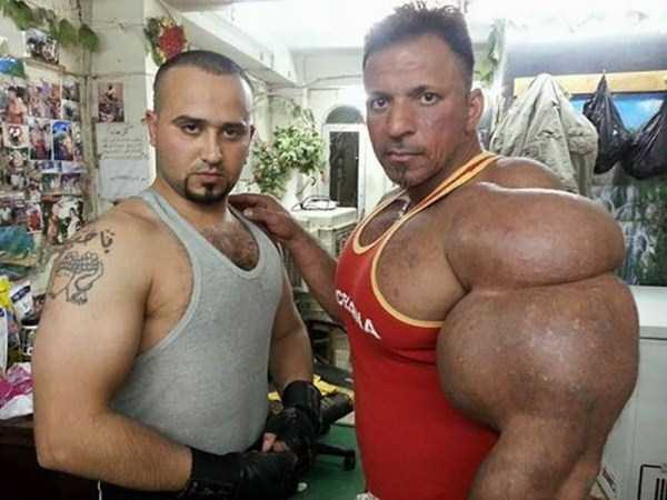 When Steroid Use Goes Terribly Wrong