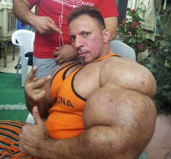 When Steroid Use Goes Terribly Wrong