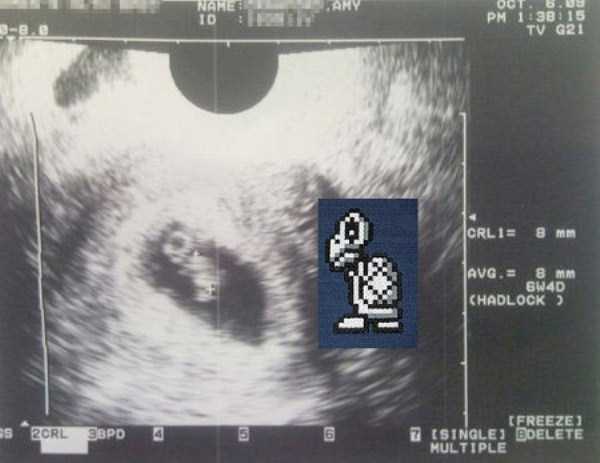 Funny Things Detected By Ultrasound