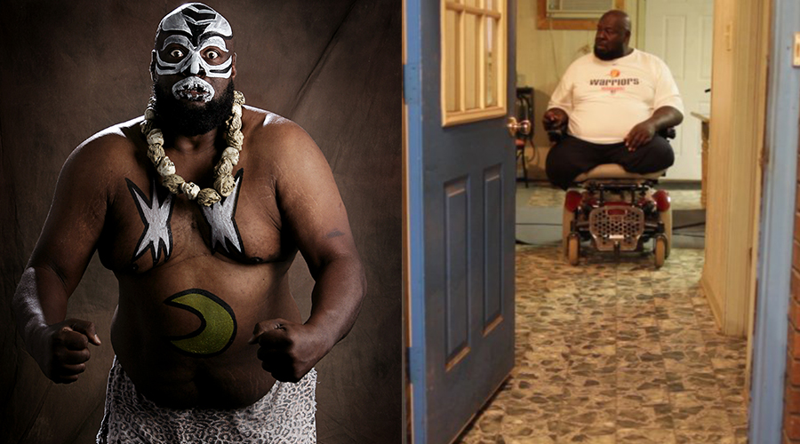 Kamala The Ugandan Giant: Double Amputee due to complications of high blood pressure and diabetes.