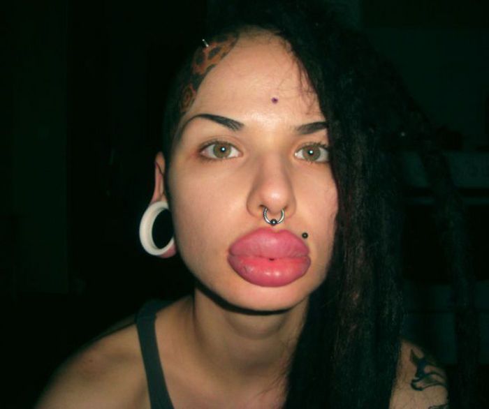 Lip Injection