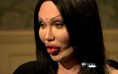 Botched Plastic Surgery