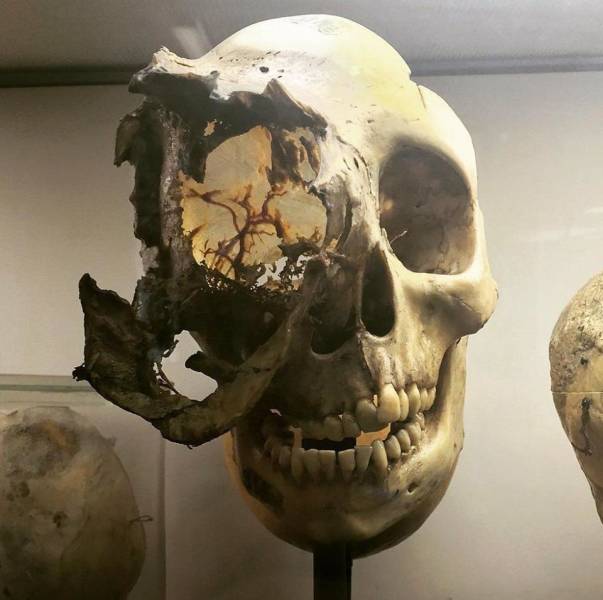 The skull of a person with the rare type of bone cancer Chordoma.