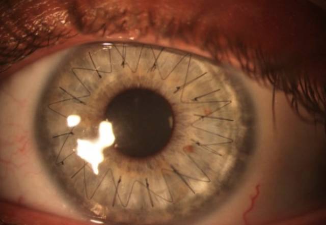 An eyeball after a cornea transplant. These are the stitches.