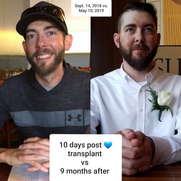 beard - Sept. 14, 2018 vs. 10 days post transplant Vs 9 months after