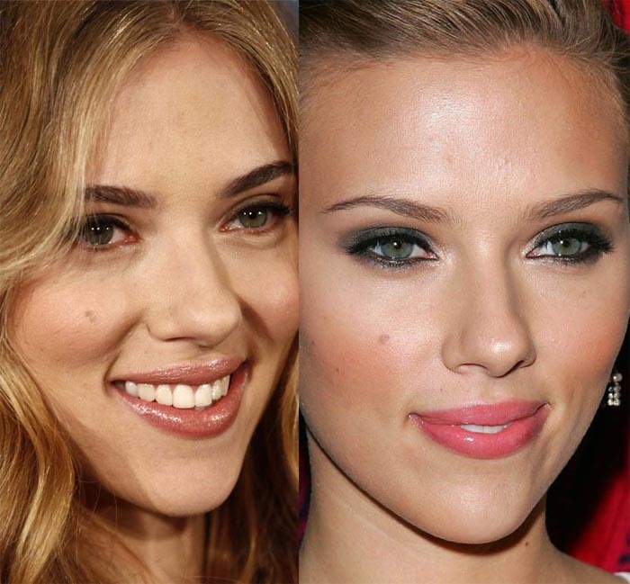 scarlett johansson before and after breast implants