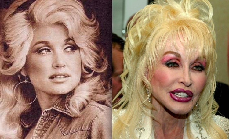 dolly parton before and after plastic surgery