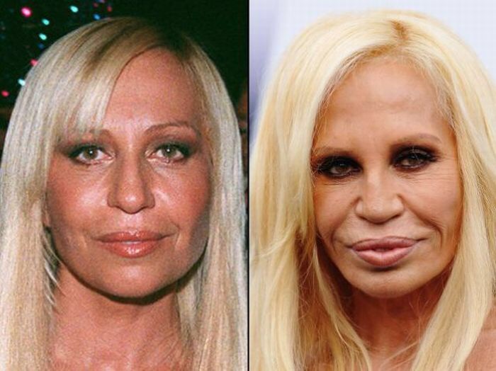 plastic surgery before and after