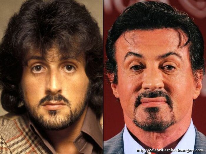 sylvester stallone before after -