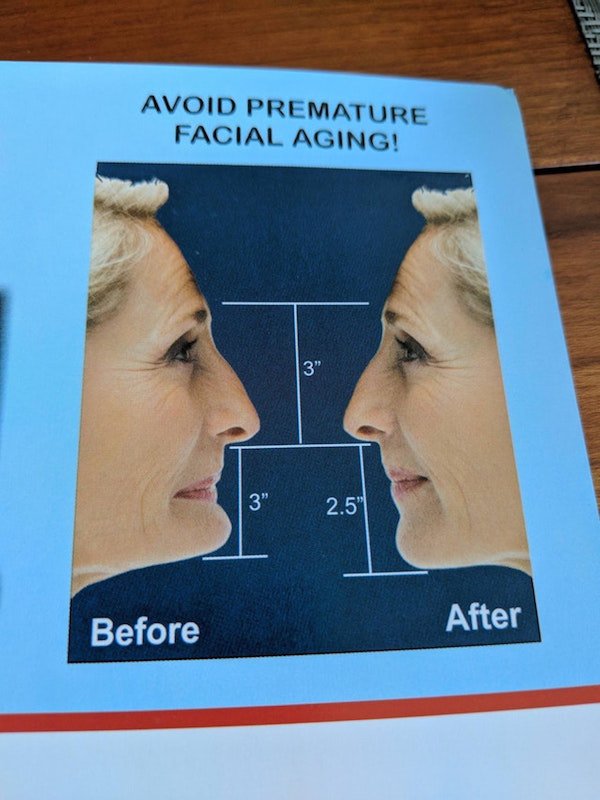 jaw - Avoid Premature Facial Aging! 2.5" Before After