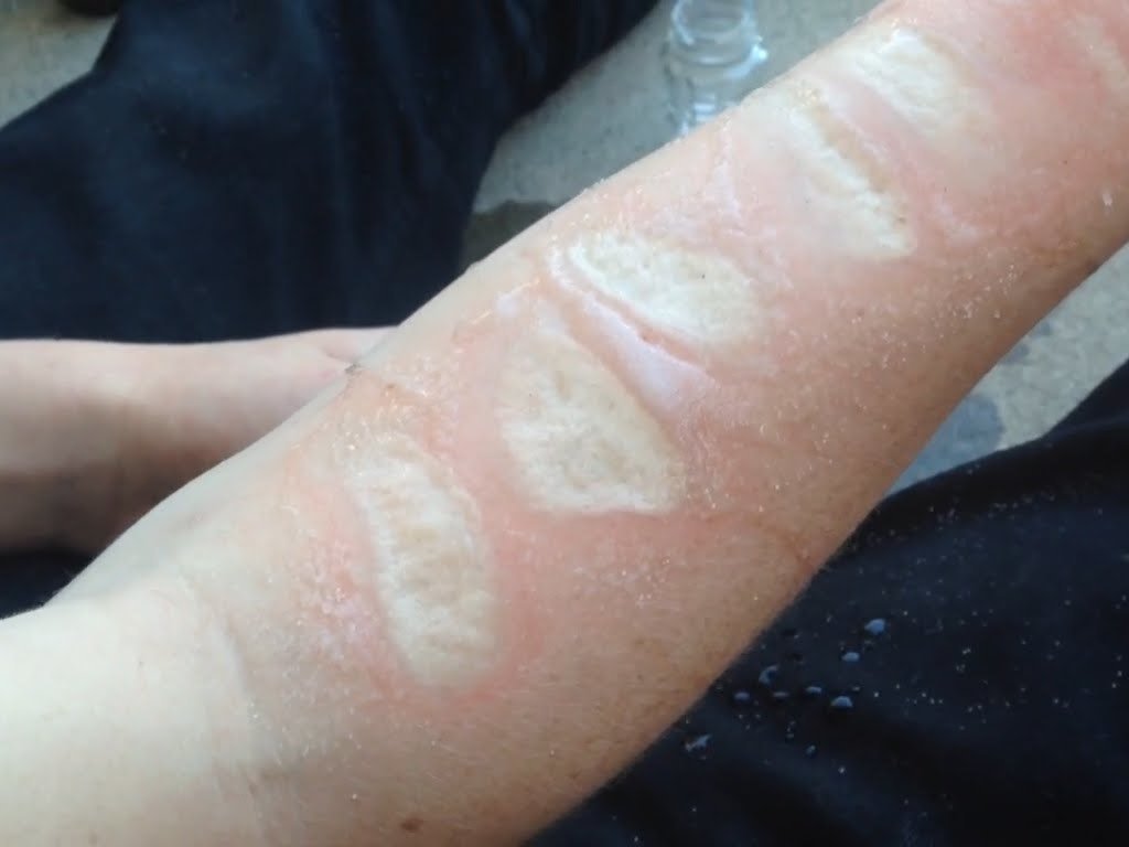 Kids will put salt and ice on their skin, then see how long they can endure the burn.