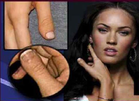 Megan Fox has brachydactlytype D BDD, clubbed thumb