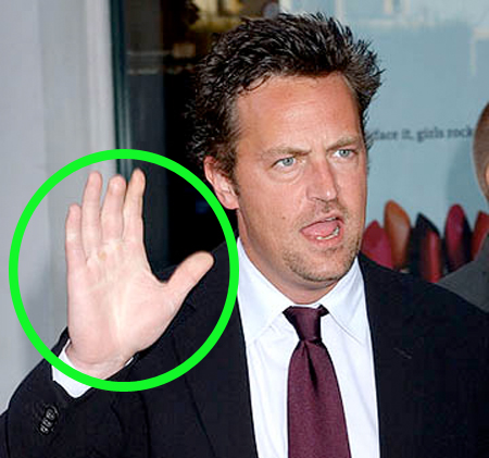 Matthew Perry lost the top portion of his middle finger in a childhood accident