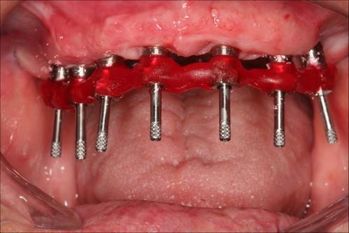 Dental implant posts. As a more permanent solution than dentures the dental implants are drilled and screwed in the jawbone and then a series of crowns are made to retrofit on top of the implant posts which is what you see here. This is just the beginning process of getting the implant crowns.