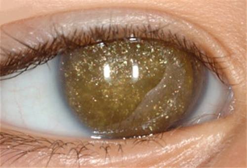 Anterior segment of the right eye filled with refractile yellow crystals in the treatment of retinoblastoma.