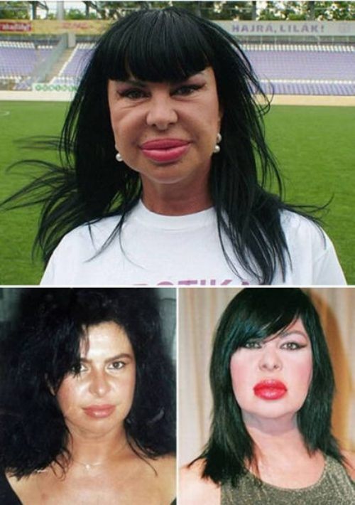 Plastic Surgery Gone Wrong