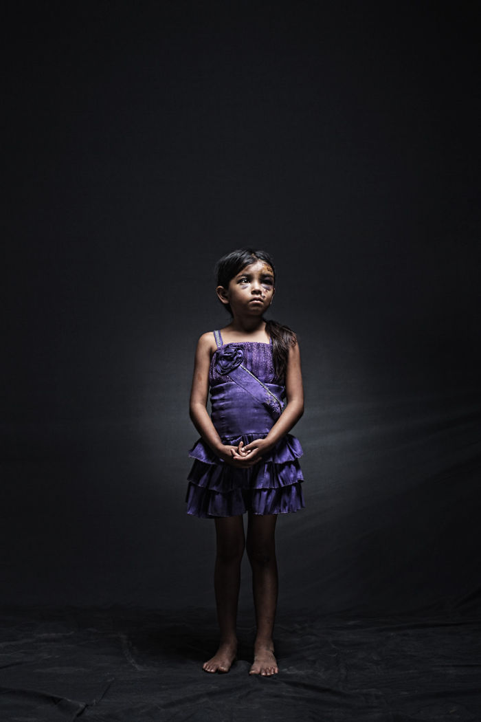 Yenifer, 8, Guatemala. She suffered, along with her 12 year old sister and 11 other migrants, from an automobile accident in Chiapas. The accident was caused by a flat front tire of the truck they were in. The driver died, leaving her in the company of strangers in an attempt to get to the United States.
