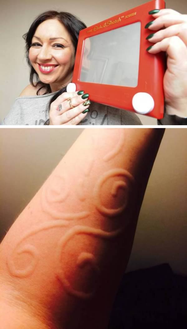 The Human Etch a Sketch - The 43-year-old has a condition called dermatographia. The slightest scratch can cause her skin to swell. It also allows her to create designs and words on her body which vanish within an hour.
