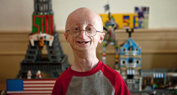Progeria: This is an aging disease that causes children to age very rapidly. They very rarely live to be older than their teens.
