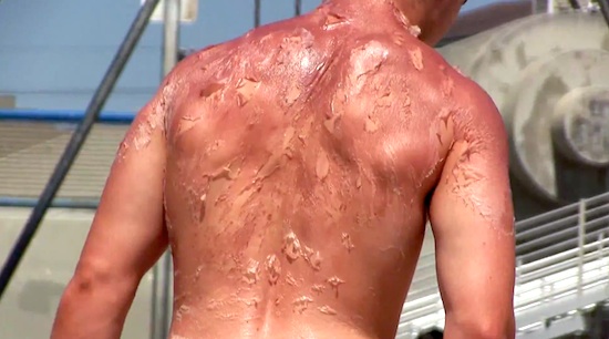 Sunburn Art is a Real Thing, and It's Glorious