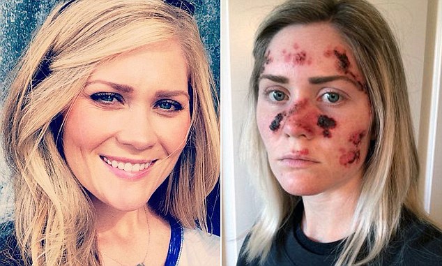 Willoughby was first diagnosed with skin cancer at age 21, and now goes to the dermatologist every six to 12 months The painful picture, showing bright red scabs and bloodied blisters, has been shared more than 50,000 times as a stunning warning about the dangers of skin cancer.