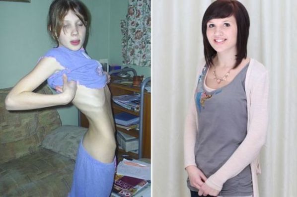 Girls Suffered From Anorexia Nervosa Gallery