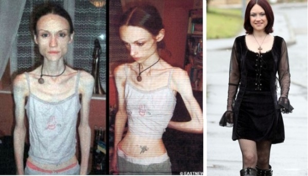 Girls Suffered From Anorexia Nervosa