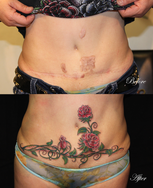 c section tattoo - Before After