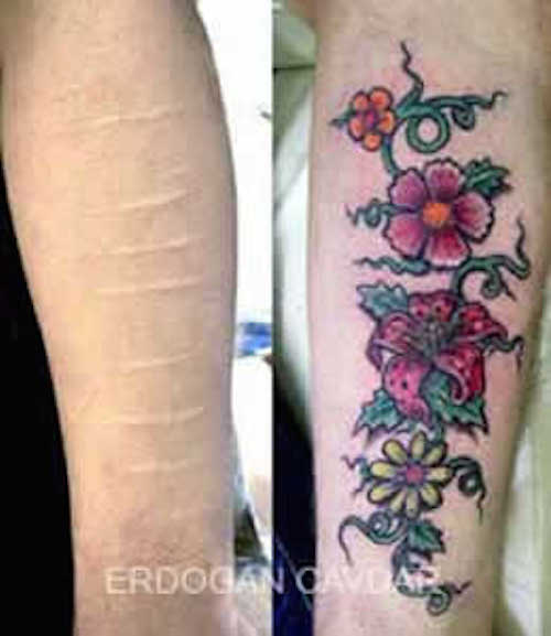 will tattoos cover scars - Erdogan