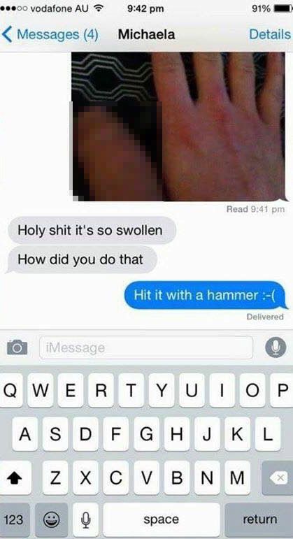 Guy Tricks Girl Into Thinking He Had A Really Swollen Thumb
