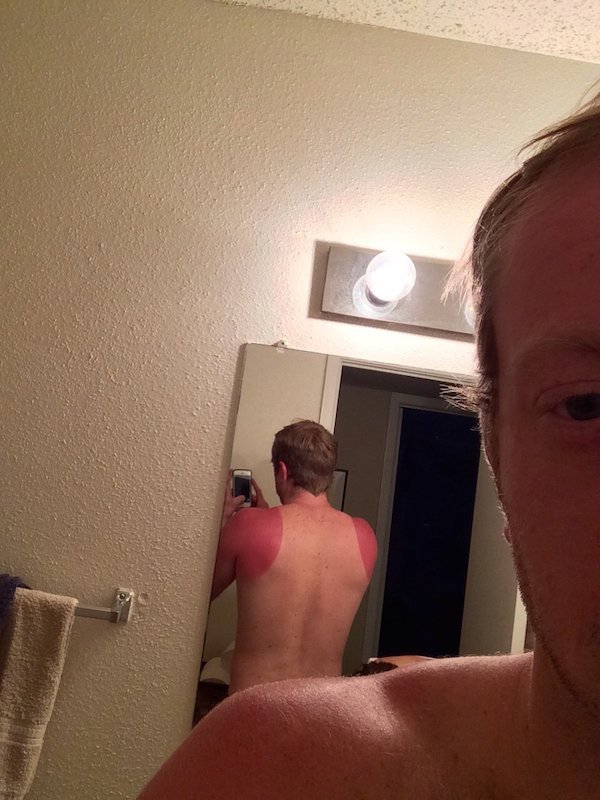 painful picture of man's sunburn