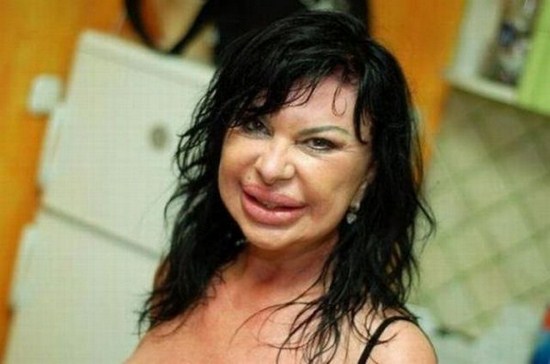 30 Horrifying Results of Terrible Plastic Surgery