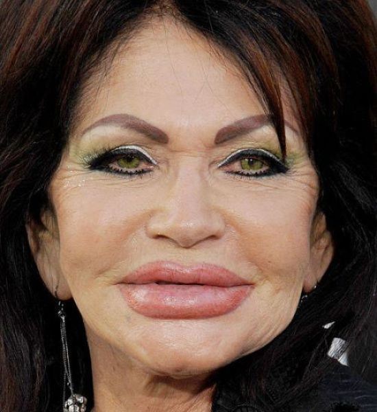 30 Horrifying Results Of Terrible Plastic Surgery Wtf Gallery Ebaum S World