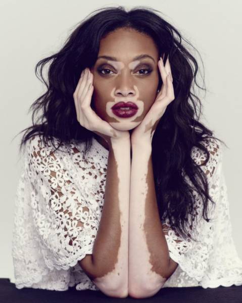 Chantelle Brown-Young

This Canadian model has been suffering from a skin pigmentation defect since she was three years old. She managed to turn her deficiency into an advantage and became a model.