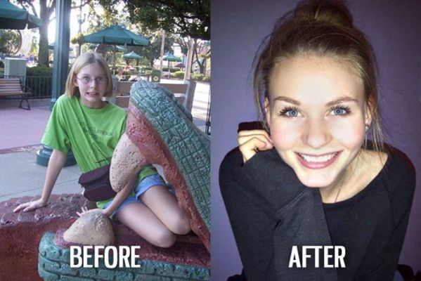 ugly people who became pretty - 'S Before After