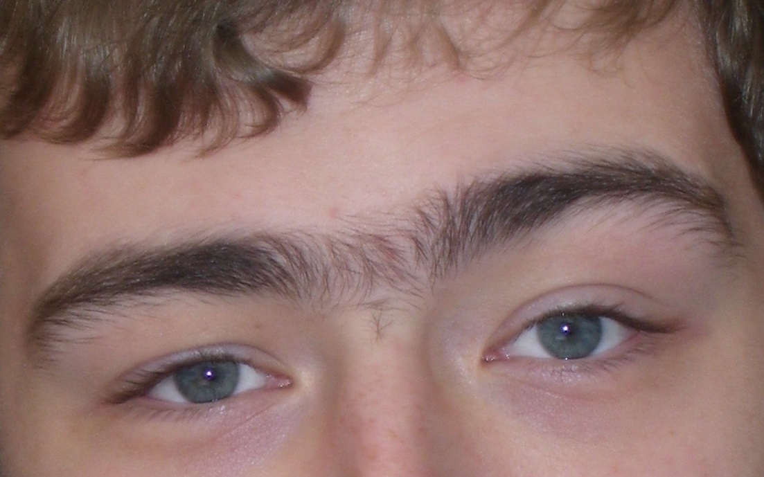 hair between eyebrows