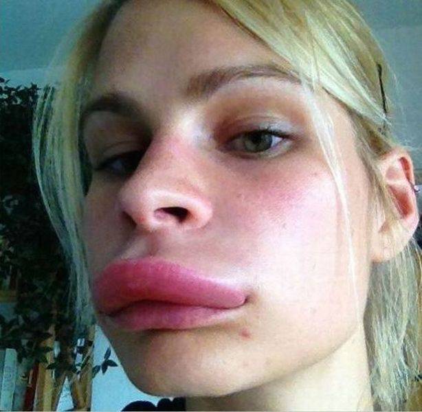 mosquito bite on lip