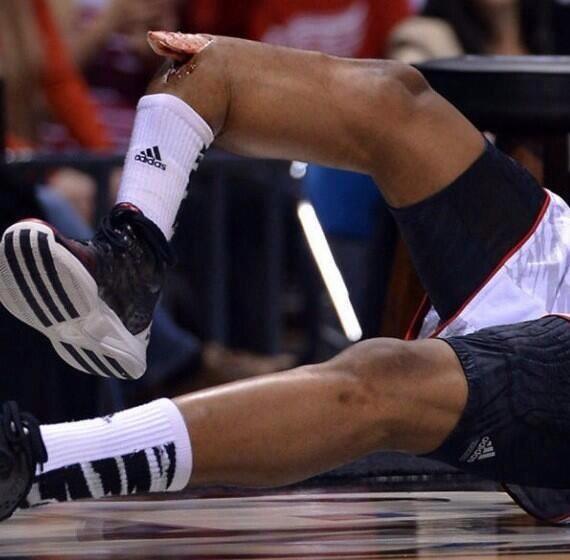 Louisville basketball player Kevin Ware suffered a gruesome injury in the team's Elite 8 game on Sunday afternoon.  The sophomore broke his leg towards the end of the second half of the Midwest Regional final against Duke. After landing on his feet, Ware fractured his right tibia and saw the bone in his leg break through his skin.