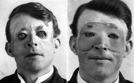 Walter Yeo, one of the first people to undergo advanced plastic surgery. His eyelids were damaged in World War I, and he got a skin transplant to replace them.