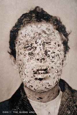 Smallpox victim, New York, 1881
