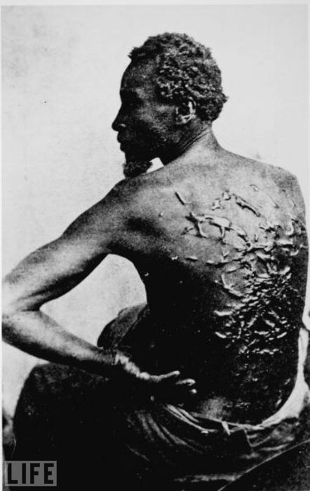 Former slave showing whipping scars