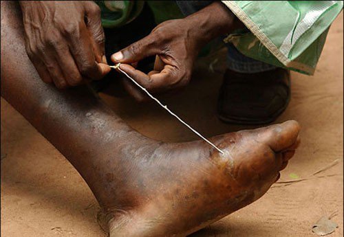 Guinea worm.


This is not simply a kid’s tale supposed to scare you but actually a parasite that can live in water.  While growing, the parasite will live in your intestines and then slowly move towards your limbs until it has found its favorite new home – which will, most likely, be one of your feet.

Once they’ve had enough, they might cause large blisters on your skin and eventually make their way out of your body again. Their extraction can be quite painful but at least the worm will be gone afterwards.