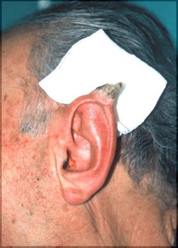 Cornu Cutaneum.


Although this tumor might look like special effects makeup, it is anything but cool. In fact, it is a specifically rare tumor caused by sun exposure or radiation and predominantly affecting elderly men.

For as long as the skin cancer has not spread, it can be removed via surgery and the patient is considered cured.