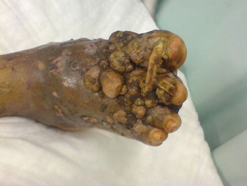 Madura Foot.


This chronic fungal disease is also known as Eumycetoma. Usually, this disease is caused by certain fungi entering the body through open skin cuts. The infection is not painful at first and could then spread to the bone tissue. Most commonly, it will infect the feet but it can also spread to the hands or the back.

If not detected early enough, patients might have to face amputation of feet or hands.