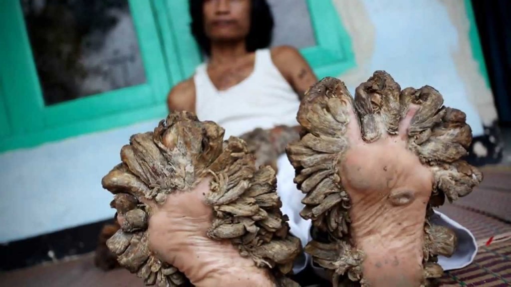 Epidermodysplasia Verruciformis.


Also known as the tree man illness, this heritable illness is caused by the human papillomavirus. Bodies are basically being overgrown by warts-like skin structures or tumors. So far surgery is the only treatment that can help patients regain some of their quality of life.