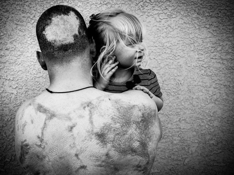Bobby Bernier’s unit was hit by a surprise artillery attack. He suffered burns to 60 percent of his body. He is pictured holding his daughter with the reminiscence of his scared tissue exposed.