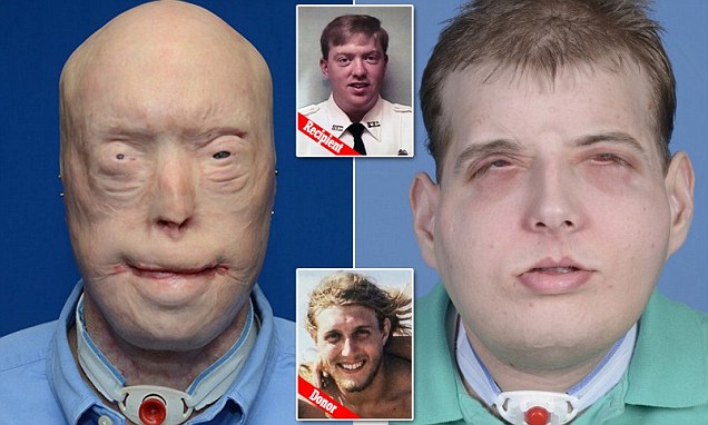Face transplant Pat Hardison, 41, a former firefighter from Tennessee, lost most of his face when his fireman’s mask melted to it during a blaze in a mobile home in 2001. He said his disfigured features (left) made his young children scream in terror – and he despaired of ever living a normal life again. But now Hardison (pictured top inset before the blaze) has been given a new face (right) – and new hope – thanks to the riskiest face transplant ever performed. 