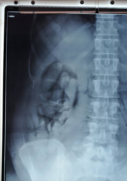 An x-ray showing swallowed packets inside a person's body, confiscated by the UK Border Agency