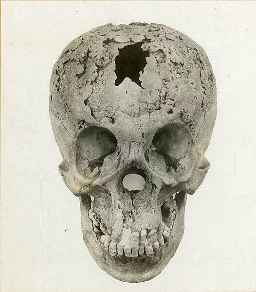 Human skull with late stage syphilis